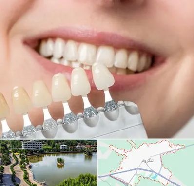 مرکز کامپوزیت دندان در لنگرود