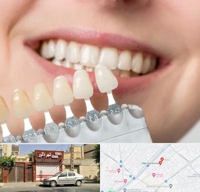 مرکز کامپوزیت دندان در باجک قم