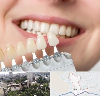 مرکز کامپوزیت دندان در اوین