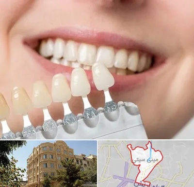 مرکز کامپوزیت دندان در مینی سیتی