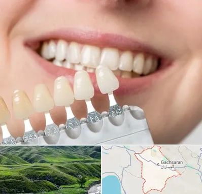 مرکز کامپوزیت دندان در گچساران