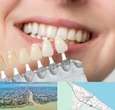 مرکز کامپوزیت دندان در تنکابن