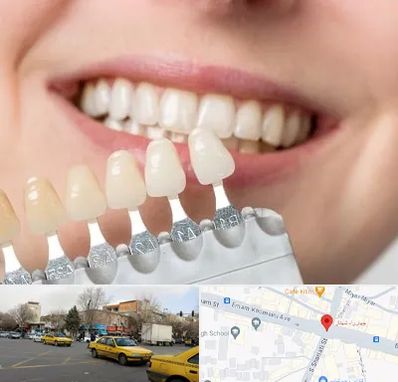 مرکز کامپوزیت دندان در شهناز تبریز