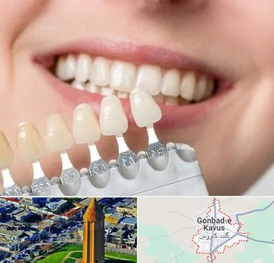 مرکز کامپوزیت دندان در گنبد کاووس
