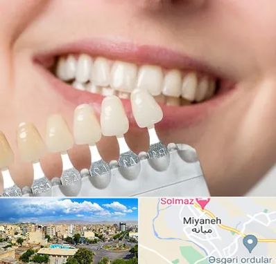 مرکز کامپوزیت دندان در میانه