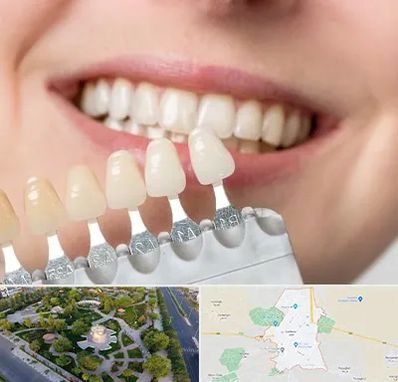 مرکز کامپوزیت دندان در کاشمر