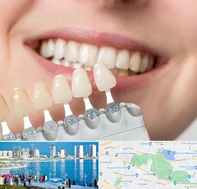 مرکز کامپوزیت دندان در چیتگر