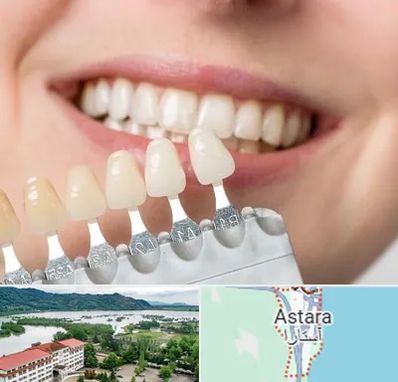 مرکز کامپوزیت دندان در آستارا