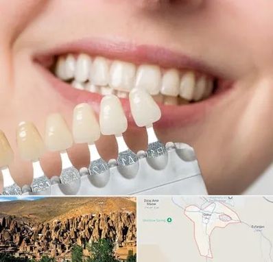 مرکز کامپوزیت دندان در اسکو