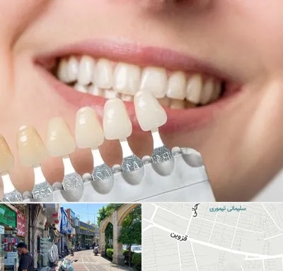 مرکز کامپوزیت دندان در خیابان قزوین