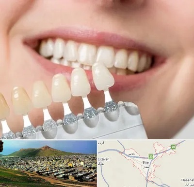 مرکز کامپوزیت دندان در بیجار