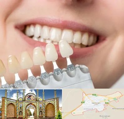 مرکز کامپوزیت دندان در سمنان