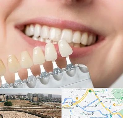 مرکز کامپوزیت دندان در کوی وحدت شیراز