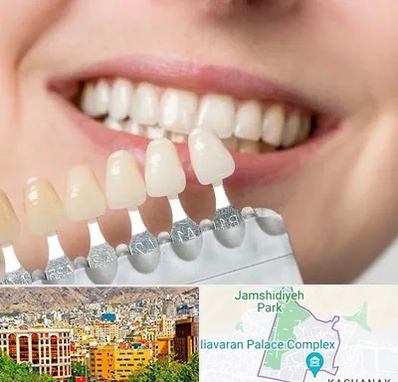 مرکز کامپوزیت دندان در نیاوران