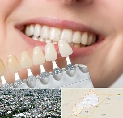 مرکز کامپوزیت دندان در شاهرود