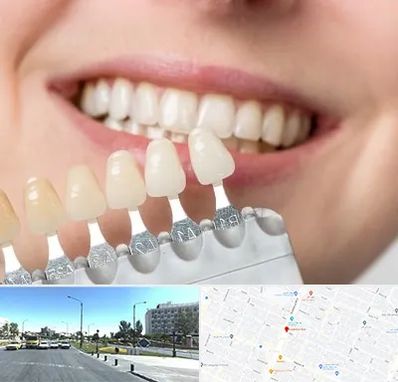 مرکز کامپوزیت دندان در بلوار کلاهدوز مشهد