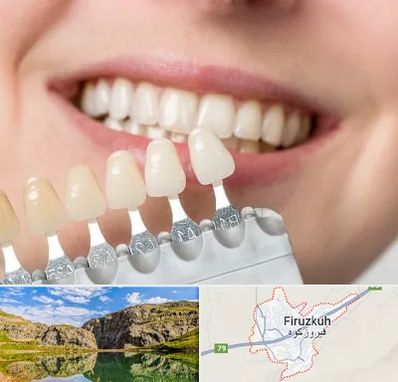 مرکز کامپوزیت دندان در فیروزکوه