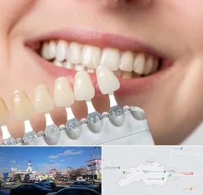 مرکز کامپوزیت دندان در ماهدشت کرج