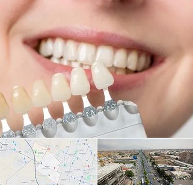 مرکز کامپوزیت دندان در حصارک کرج