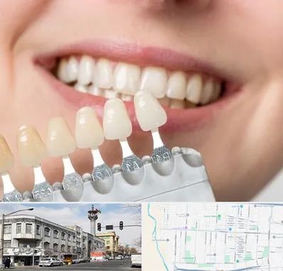 مرکز کامپوزیت دندان در 17شهریور