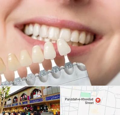 مرکز کامپوزیت دندان در 15 خرداد