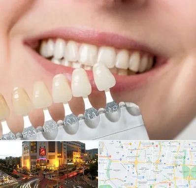 مرکز کامپوزیت دندان در جنت آباد تهران