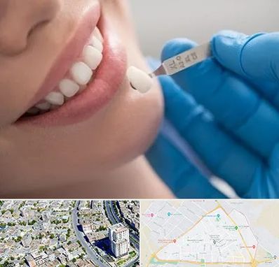 مرکز لمینت دندان در قاسم آباد مشهد