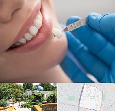 مرکز لمینت دندان در باغمیشه تبریز