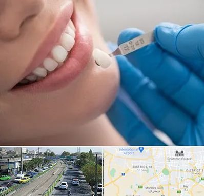 مرکز لمینت دندان در جنوب تهران