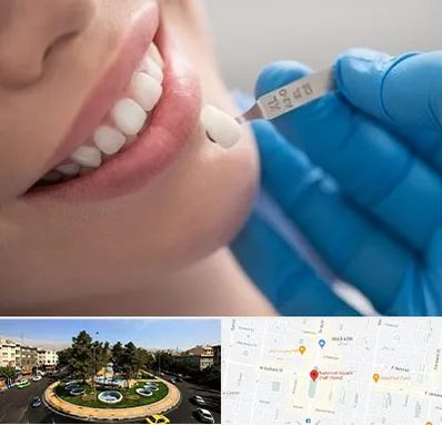 مرکز لمینت دندان در هفت حوض