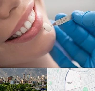 مرکز لمینت دندان در جمشیدیه