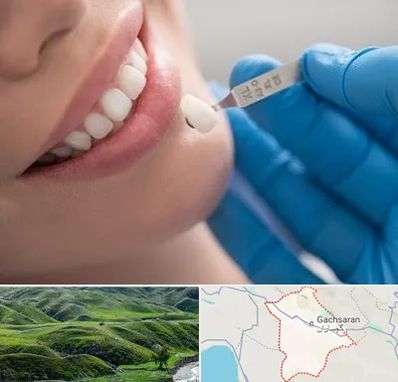 مرکز لمینت دندان در گچساران