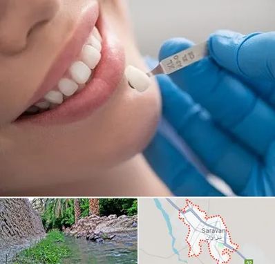 مرکز لمینت دندان در سراوان
