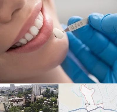 مرکز لمینت دندان در اوین