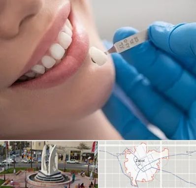 مرکز لمینت دندان در زابل