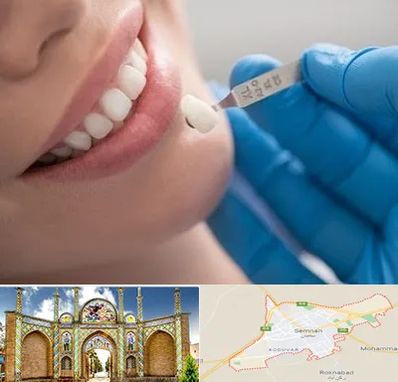 مرکز لمینت دندان در سمنان