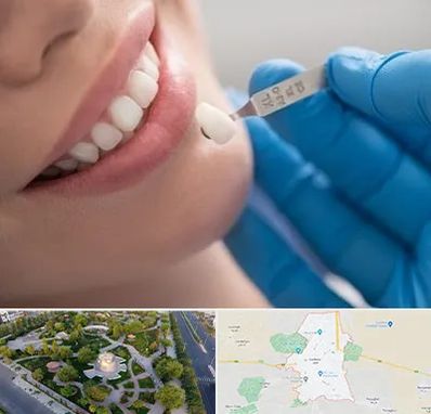 مرکز لمینت دندان در کاشمر