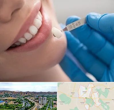 مرکز لمینت دندان در شهریار