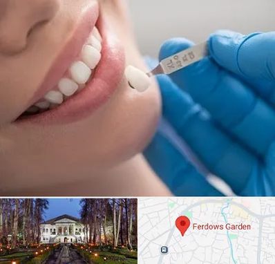 مرکز لمینت دندان در باغ فردوس