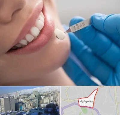 مرکز لمینت دندان در محمودیه