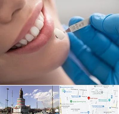 مرکز لمینت دندان در کارگر جنوبی