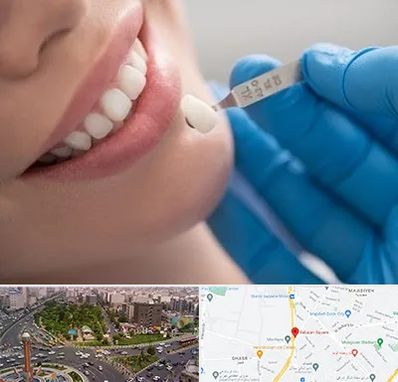 مرکز لمینت دندان در سبلان