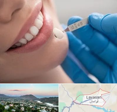 مرکز لمینت دندان در لواسان