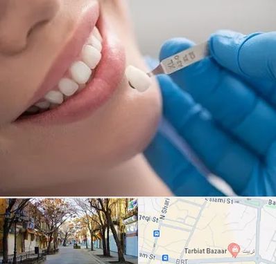 مرکز لمینت دندان در تربیت تبریز