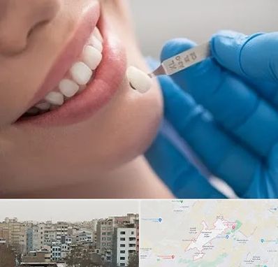 مرکز لمینت دندان در محمد شهر کرج