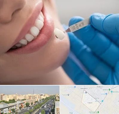 مرکز لمینت دندان در کیانمهر کرج