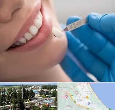 مرکز لمینت دندان در رودسر