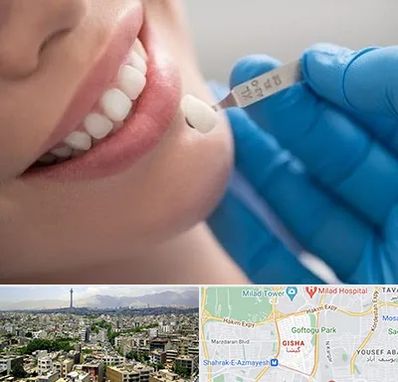 مرکز لمینت دندان در گیشا