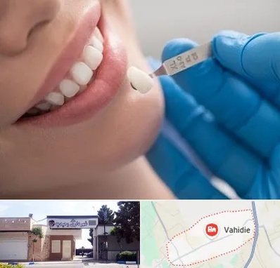 مرکز لمینت دندان در وحیدیه شهریار