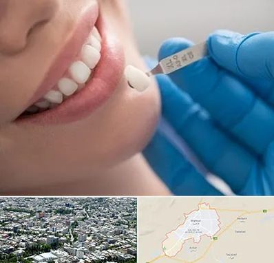 مرکز لمینت دندان در شاهرود